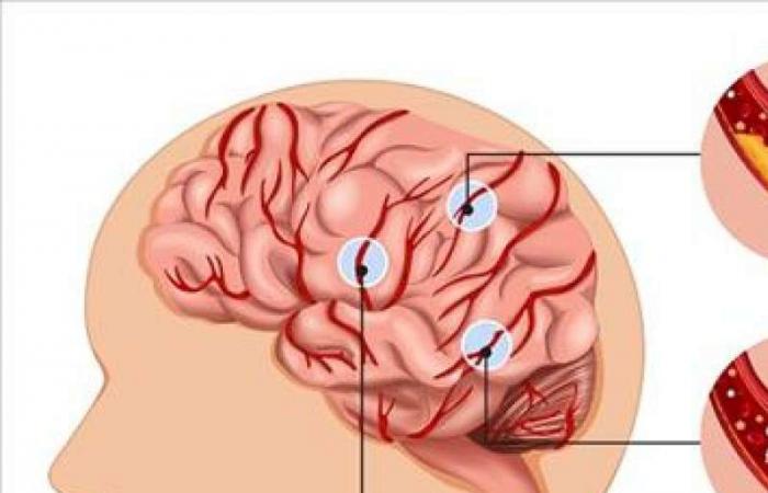 6 عوامل تصيب الشباب في سن الأربعين بالسكتة الدماغية - بلس 48