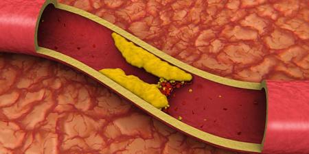بالبلدي : طرق طبيعية لعلاج الكوليسترول الضار بالمنزل.. ما دور التدخين؟ - بلس 48