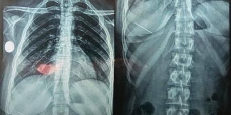 بلعت دبوس.. إنقاذ فتاة من اختناق حاد في مستشفيات جامعة المنوفية - بلس 48