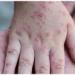 بالبلدي: India Reports Its First Case of Virulent Mpox Virus Strain - بلس 48