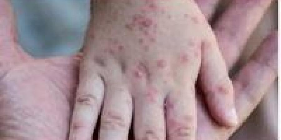 بالبلدي: India Reports Its First Case of Virulent Mpox Virus Strain - بلس 48